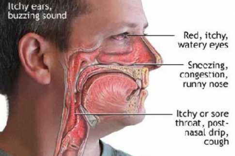 নাকের এলার্জি রাইনাটিস